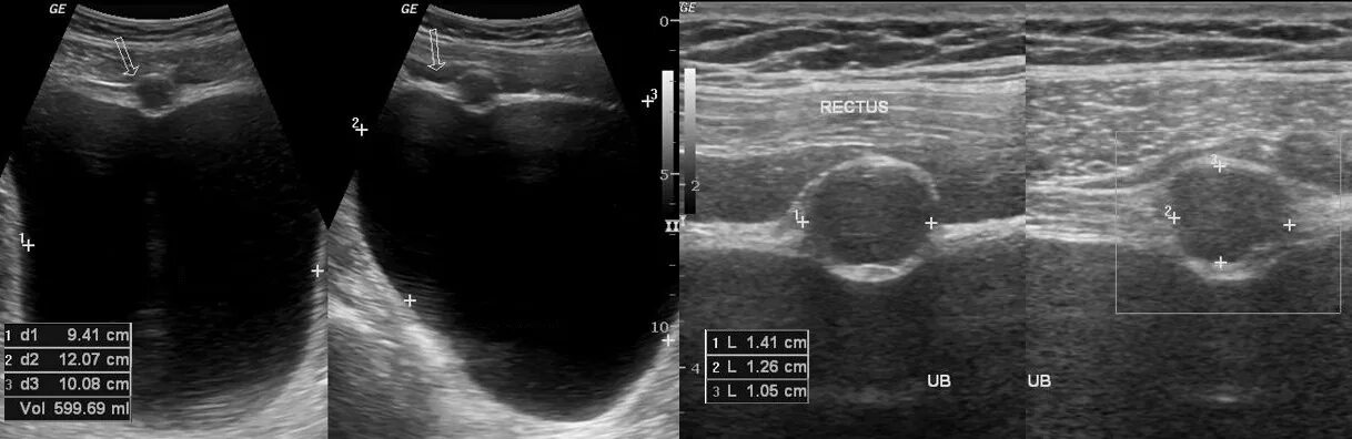 Киста у мужчин на узи. Урахус мочевого пузыря на УЗИ. Киста урахуса в мочевом пузыре. Киста урахуса УЗИ картина.