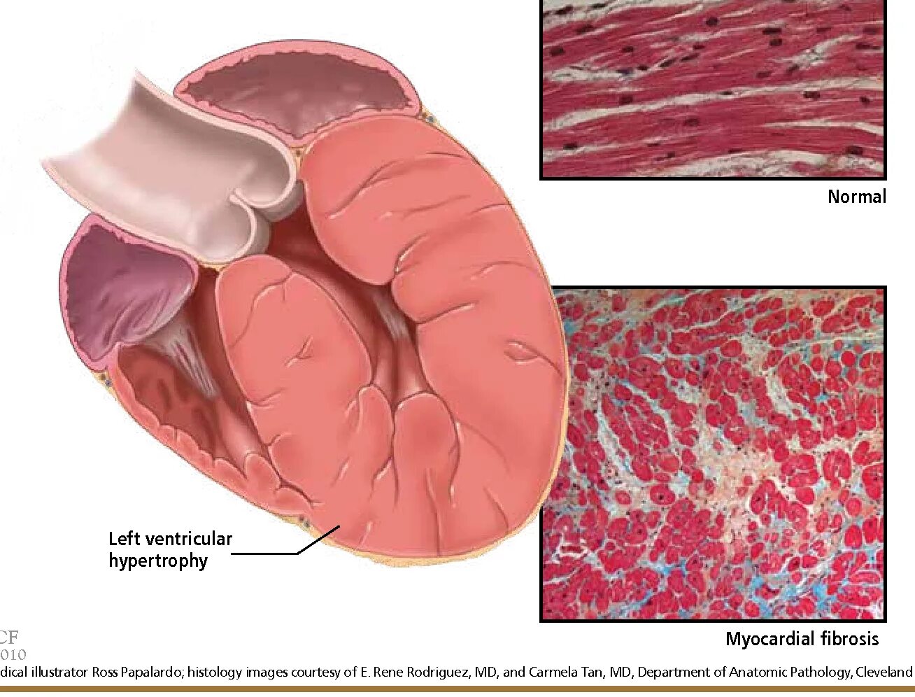 Заболевания левого желудочка. Фиброз миокарда желудочков. Фиброз миокарда левого желудочка. Фиброз миокарда гистология. Гипертрофия миокарда макропрепарат.