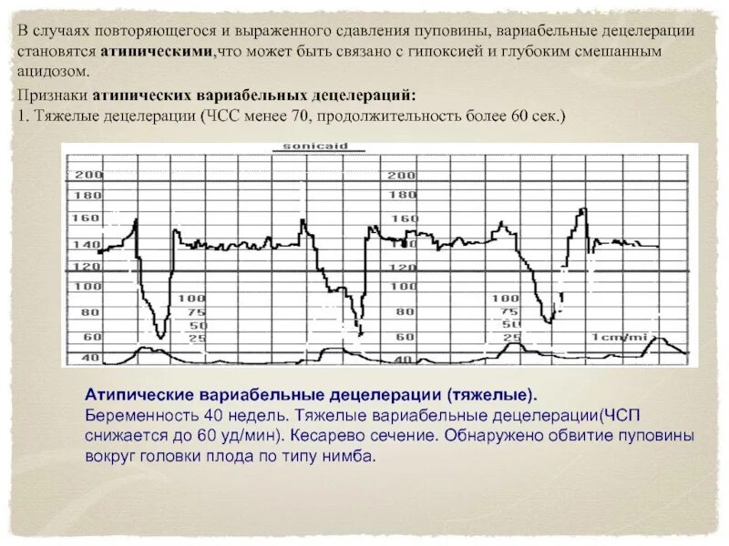 Нормальная диаграмма ктг. Вариабельность сердечного ритма норма у плода. Синусовый ритм ктг. Сердцебиение плода на 10 неделе беременности норма. Нормальный тип кривой ктг.