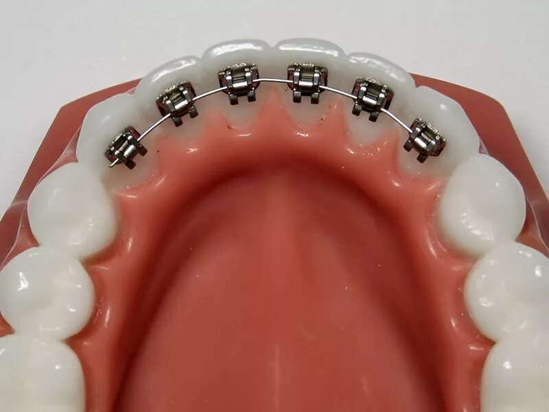 эстетические брекеты. незаметные брекеты. незаметные брекеты. невидимые (лингвальные) брекеты.