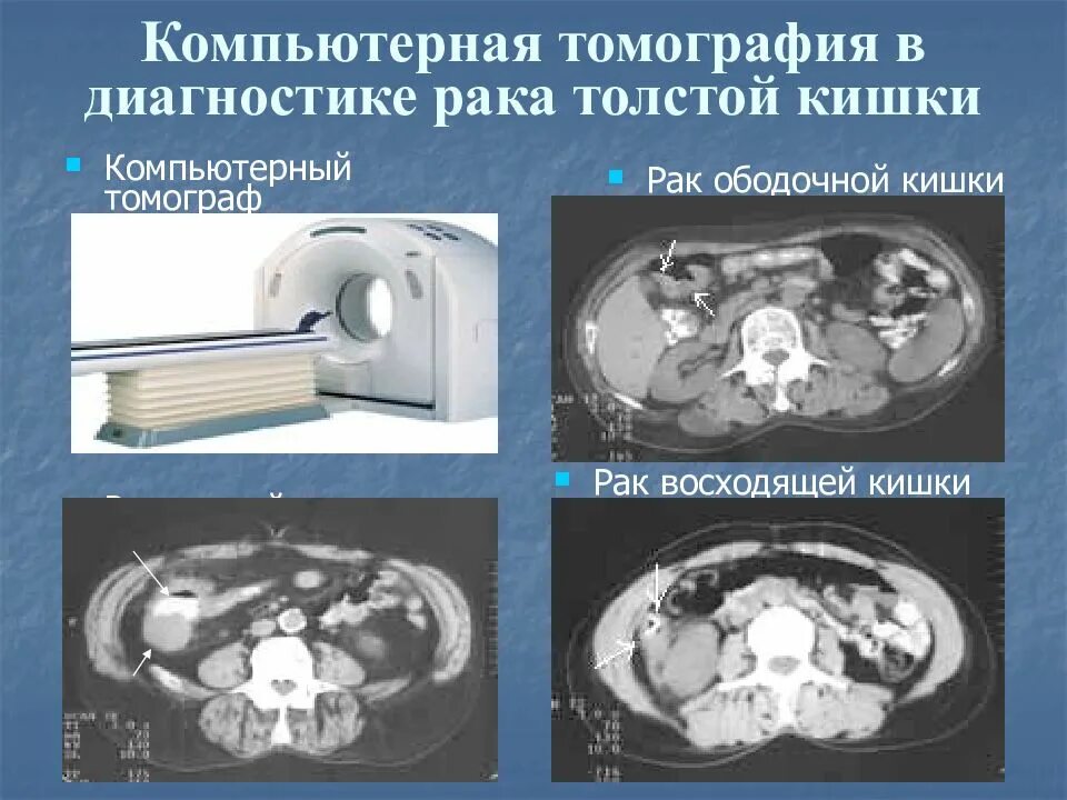 Рак прямой кт