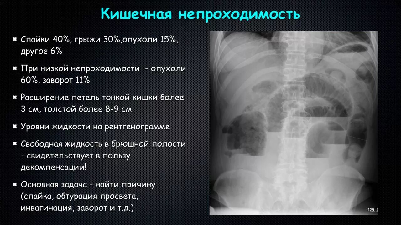 Непроходимость кишечника при онкологии. Кишечная непроходимость ирригоскопия. инвагинация кишечника рентген. толстокишечная непроходимость. рентген брюшной полости с описанием.