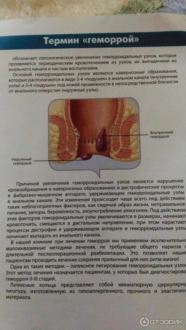 Внешний наружный геморрой. Наружные узелки геморроя. Трещина в заднем проходе кровоточит