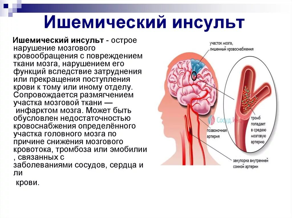 Инсульт органа. Ишемический инсульт головного мозга последствия. Синдромы ОНМК ишемический инсульт. Ишемический инсульт симптомы поражения. Осложнения ОНМК ишемический инсульт.