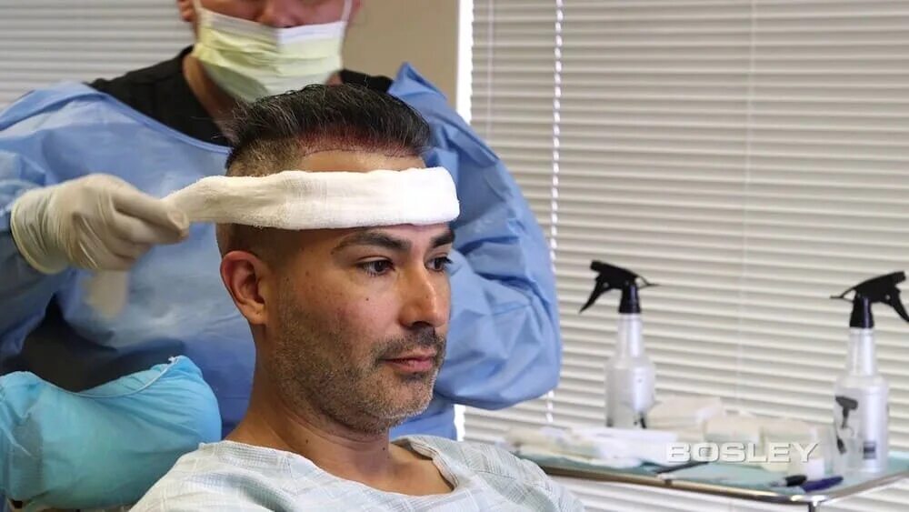 Supergreft Hair Transplant Turkey - YouTube