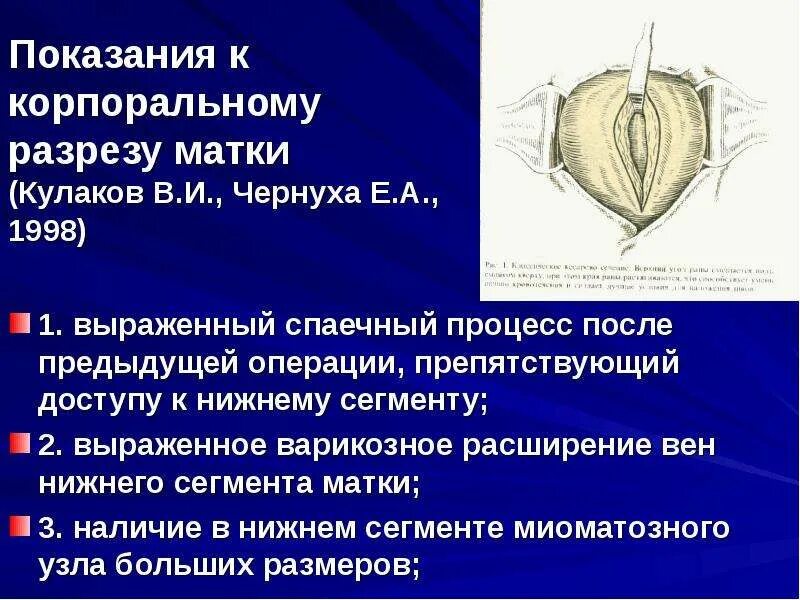 Как называется разрез при родах. Корпоральное кесарево сечение техника. корпоральное кесарево сечение разрез. разрезы при кесаревом сечении. продольный разрез на матке.