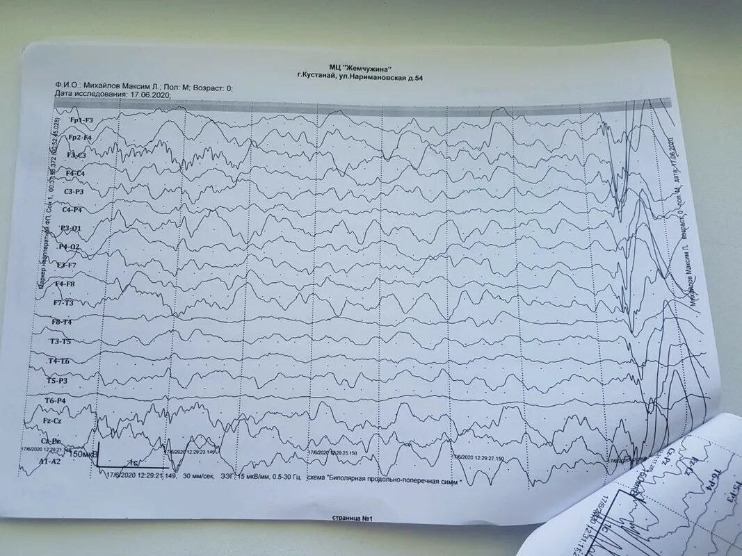 Ээг кемерово. ЭЭГ норма и патология у детей. ЭЭГ при судорогах у новорожденных. Острые волны на ЭЭГ. К-комплексы на ЭЭГ.
