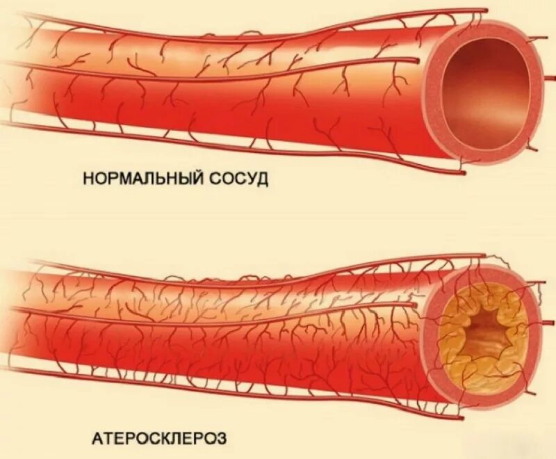 Нитевидный кровеносный сосуд. Атеросклероз коронарных артерий симптомы. Атеросклероз венечных артерий сердца. Атеросклероз сосудов брахиоцефальных артерий. Нормальный сосуд и Атеросклерозный сосуд.