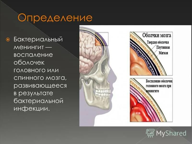 Воспаление оболочек головного и спинного мозга. Воспаление оболочек головного и спинного мозга