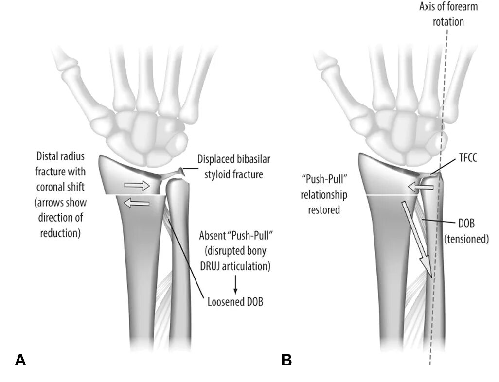 Radius fracture. T-score место ; distal radius. proximal distal.