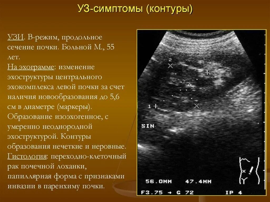 Узи лоханки почки. Расширение почечной лоханки на УЗИ. Образование почки на УЗИ В паренхиме. Диффузные изменения почек на УЗИ что это.