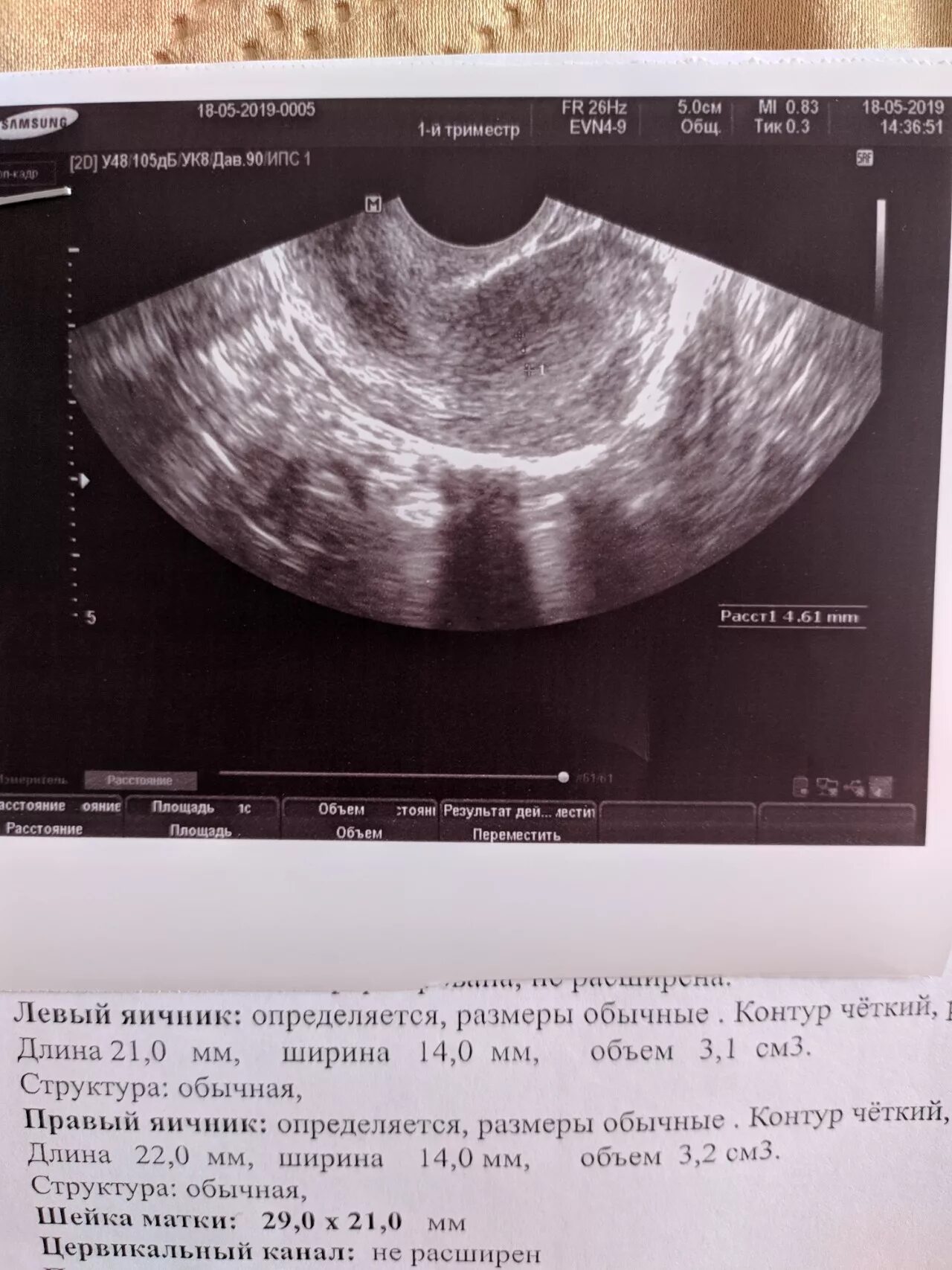 Ли узи. УЗИ беременности на ранних сроках. УЗИ на первой недели задержки.