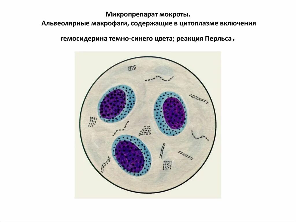 Реакция мокроты. Альвеолярные макрофаги в мокроте микроскопия. Микроскопическое исследование мокроты альвеолярные макрофаги. Альвеолярные макрофаги в мокроте нативный препарат. Альвеолярные макрофаги микропрепарат.