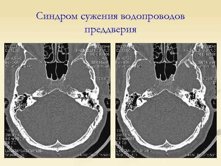 Синдром стеноза. Стеноз сильвиева водопровода. Стеноз водопровода мозга. Водопровод преддверия стеноз. Стеноз водопровода мозга УЗИ.