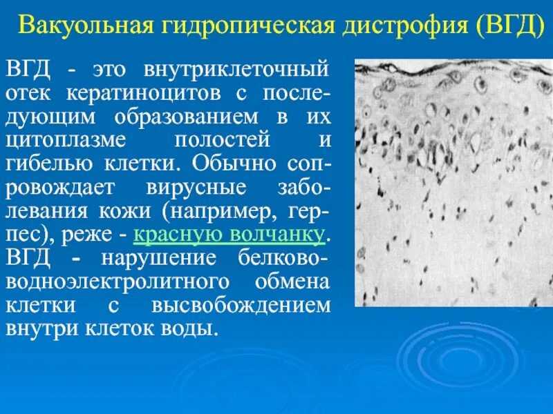 Баллонная дистрофия патанатомия. Вакуольная дегенерация. Вакуольная дистрофия эпителия канальцев почки.