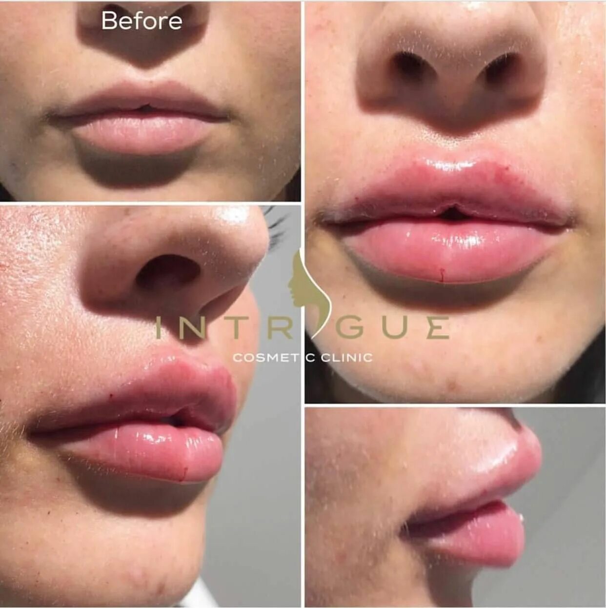Губы после ювидерм. Juvederm 1 мл увеличение губ. увеличение губ ювидерм 1 мл. ювидерм аугментация губ.