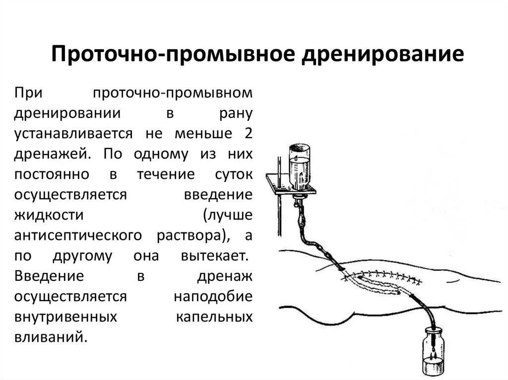 Промывание гнойной раны. Схема проточно-промывной системы для диализа раны. Схема проточно промывного дренирования. Проточно-промывное дренирование раны. Проточно-аспирационное дренирование.