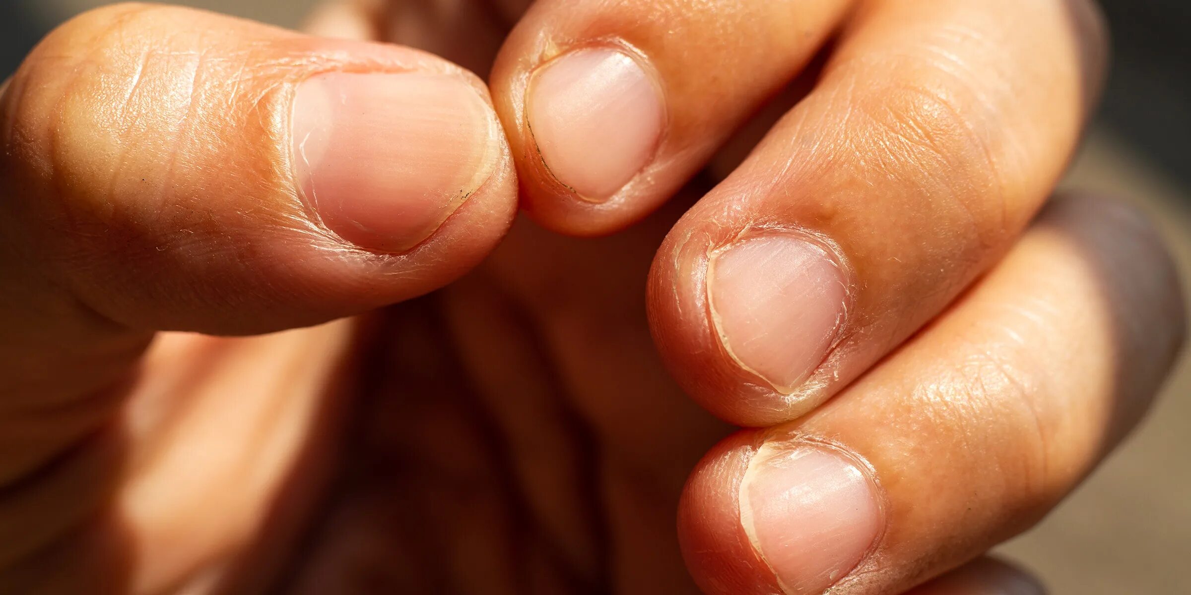 Ногти на маленькие пальцы. Микотическая лейконихия. Обгрызанные женские ногти.