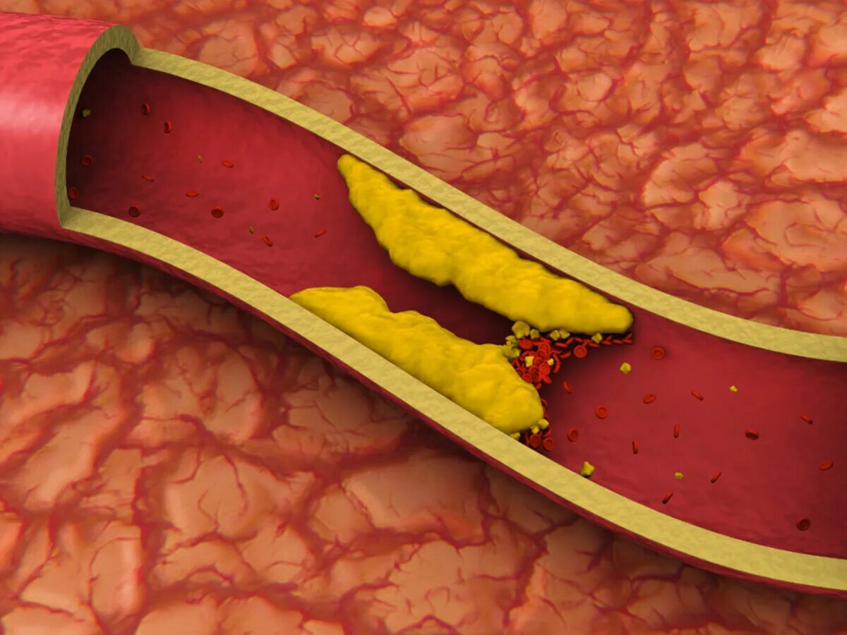 Холестерин к чему приводит. Атеросклероз холестериновая бляшка. Дистрофия сосудов атеросклероз.