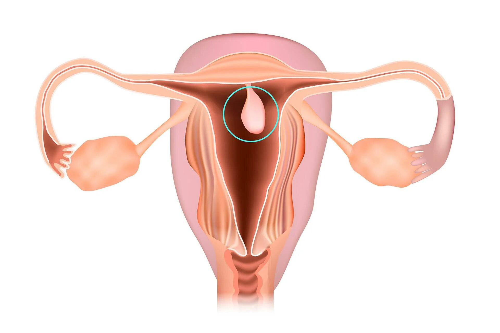 Железисто-фиброзный полип эндоцервикса. Фиброзно отечный полип. Полип в эндометрии матки. Полип эндометрит. Пролиферирующий полип эндометрия что это.