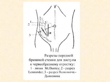Точки аппендикса