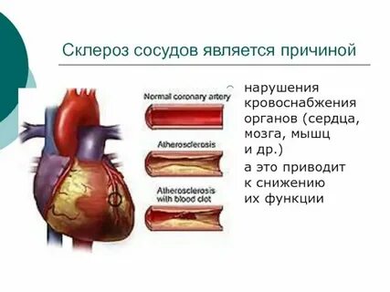 Склероз аортального клапана