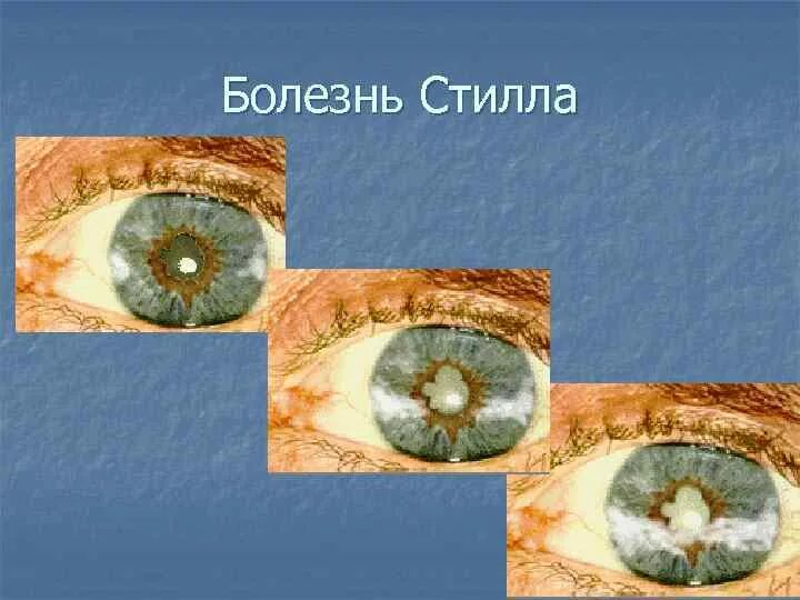 Синдром стилла суставной синдром. Стилла у взрослых. Критерии болезни стилла взрослых. Стилла у взрослых. Ревматоидный артрит синдром стилла.