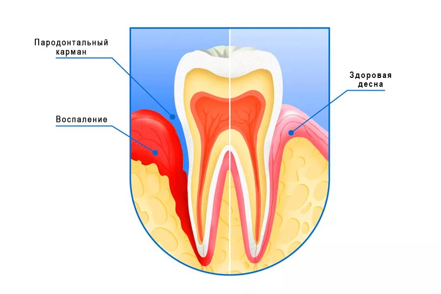 Десна отходит от зуба как лечить. Здоровый зуб гингивит пародонтит. Сильное воспаление десен. Отхождение десны от зуба. Десна отходит от зуба как лечить.