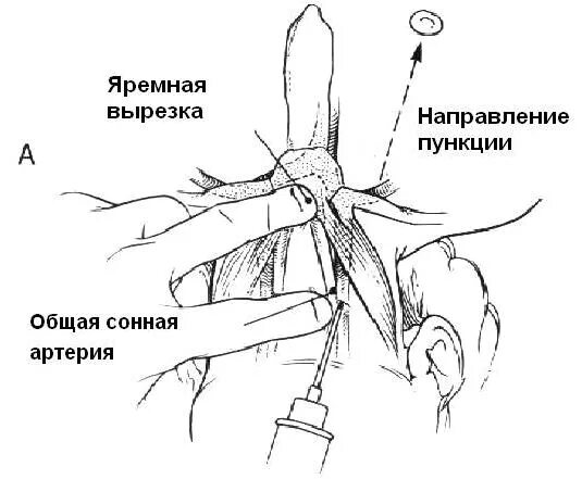 Сонная артерия у свиньи где фото. Яремная Вена техника катетеризации. Техника катетеризация внутренней яремная Вена. Внутренняя яремная Вена катетеризация. Постановка катетера в яремную Вену.