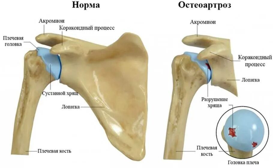 Артроз правого плечевого сустава 1ст.. Артроз плечелопаточного сустава 1 степени. Артроз плечевого сустава 1 степени рентген. Омартроз артроз плечевого сустава 1 степени. Эффективное лечение плечевого сустава