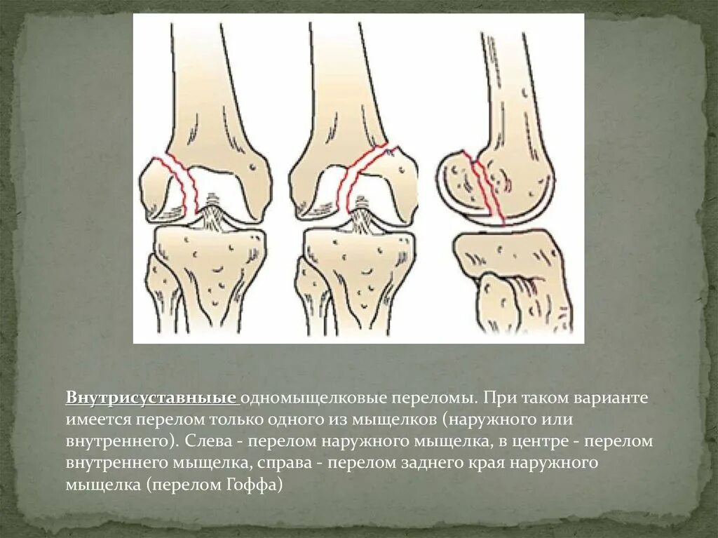 Внутренние мыщелки. Перелом мыщелков большеберцовой кости. Перелом латерального мыщелка бедренной кости. Краевой перелом мыщелка бедренной кости. Оскольчатый перелом мыщелка берцовой кости.