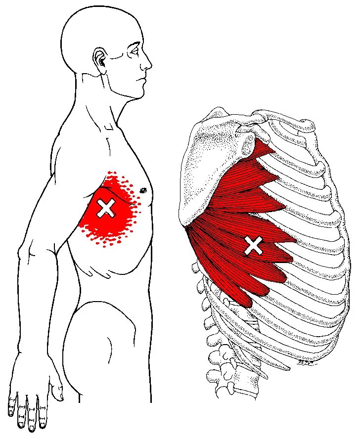 В груди сердце на спине. Триггерные точки грудной клетки. Триггерные точки мышцы грудной клетки. Болят ребра в грудной клетке.