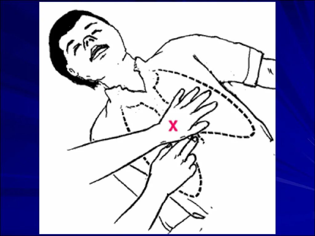 Руки в замок при сердечно легочной реанимации. Компрессии грудной клетки при СЛР. Сердечно легочная реанимация расположение рук. Точка компрессии при СЛР. Правильное расположение рук при сердечно легочной реанимации.