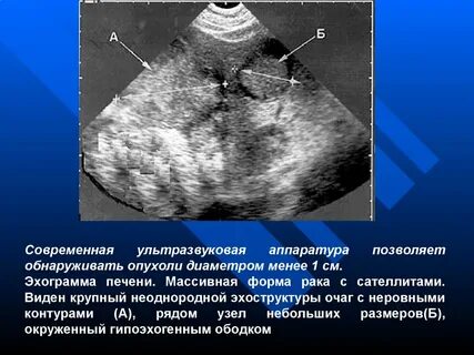 Структура поджелудочной диффузно неоднородная эхогенность повышена