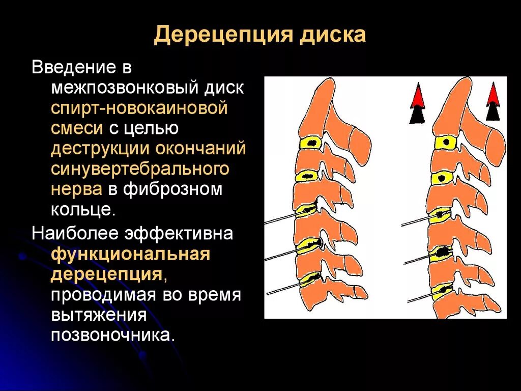 Дерецепция дисков позвоночника. Дерецепция дисков поясничного отдела. Что такое дерецепция межпозвонковых дисков. Дерецепция поясничного отдела позвоночника что это.