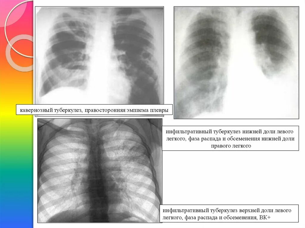 Фаза распада легких. Инфильтративный туберкулез рентгенография. Фаза обсеменения туберкулеза на рентгене. Инфильтративный туберкулез рентген. Инфильтрация туберкулез.
