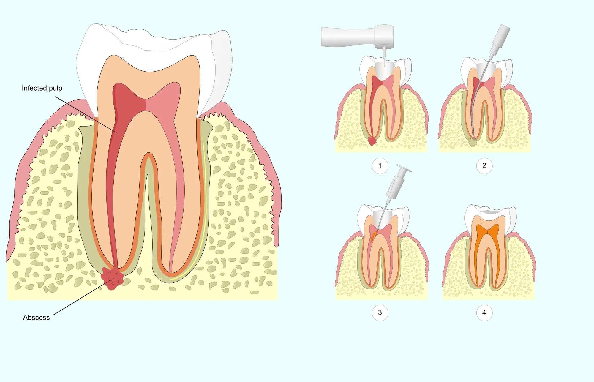 Канал гнойного. Зубы абсцесс абсцесс зуба. Подкожная гранулема зуба. Межкорневая гранулема.