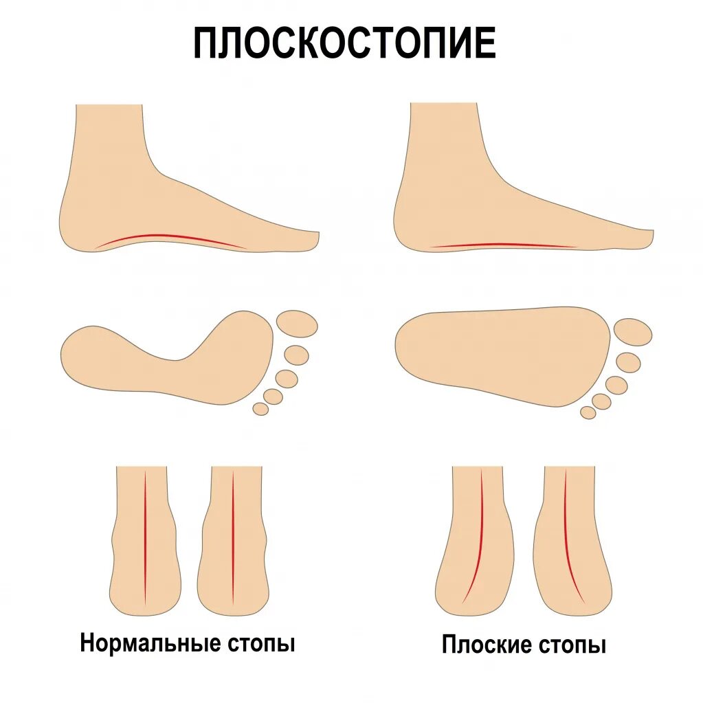 Плоская стопа. Стопа плоскостопие. Тип стопы плоскостопие. Продольное и поперечное плоскостопие у детей. Кости стопы плоскостопие.