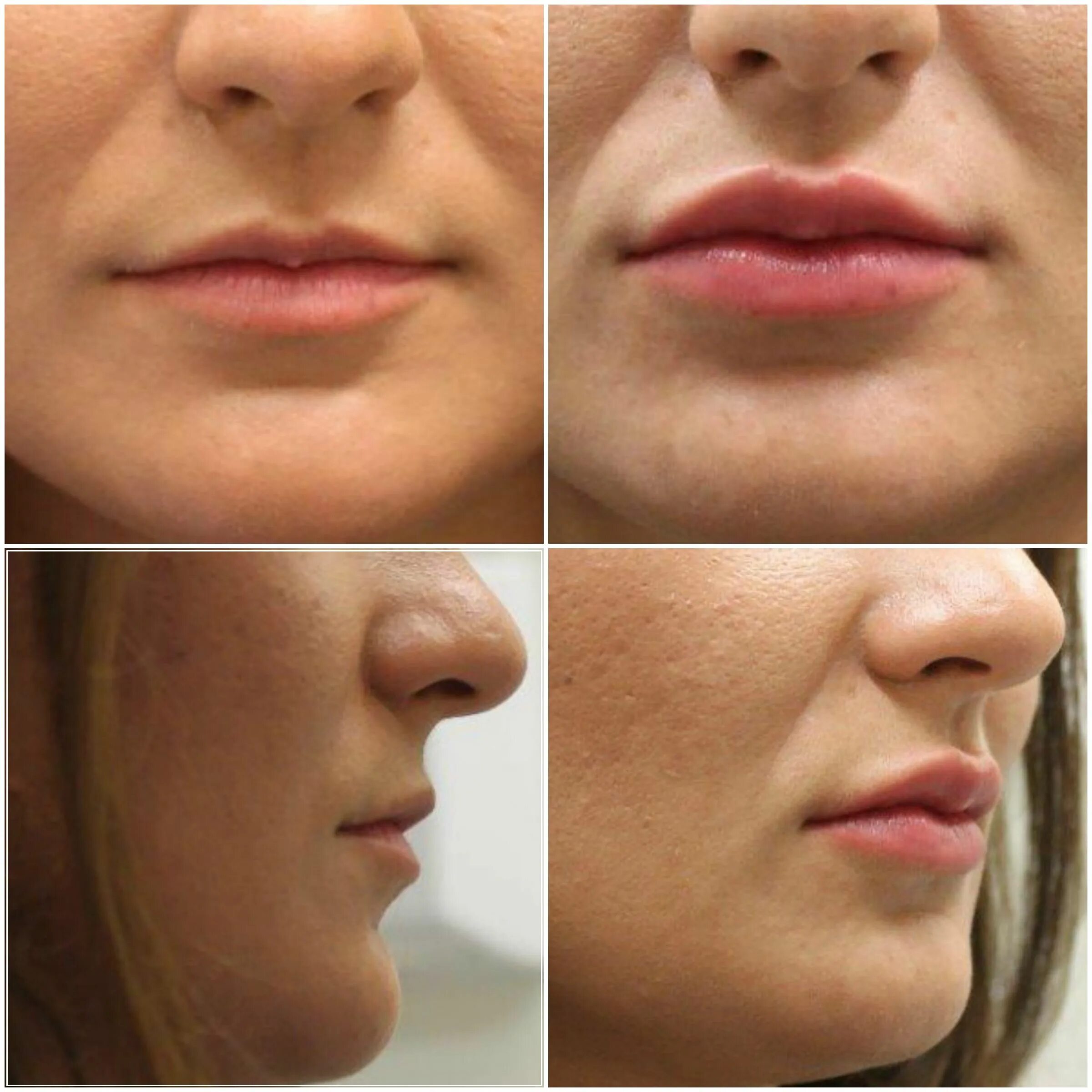 Губы 0.3 до и после Pin on Too Funny Kylie jenner lip challenge, Kylie jenner challenge, Kylie jenne