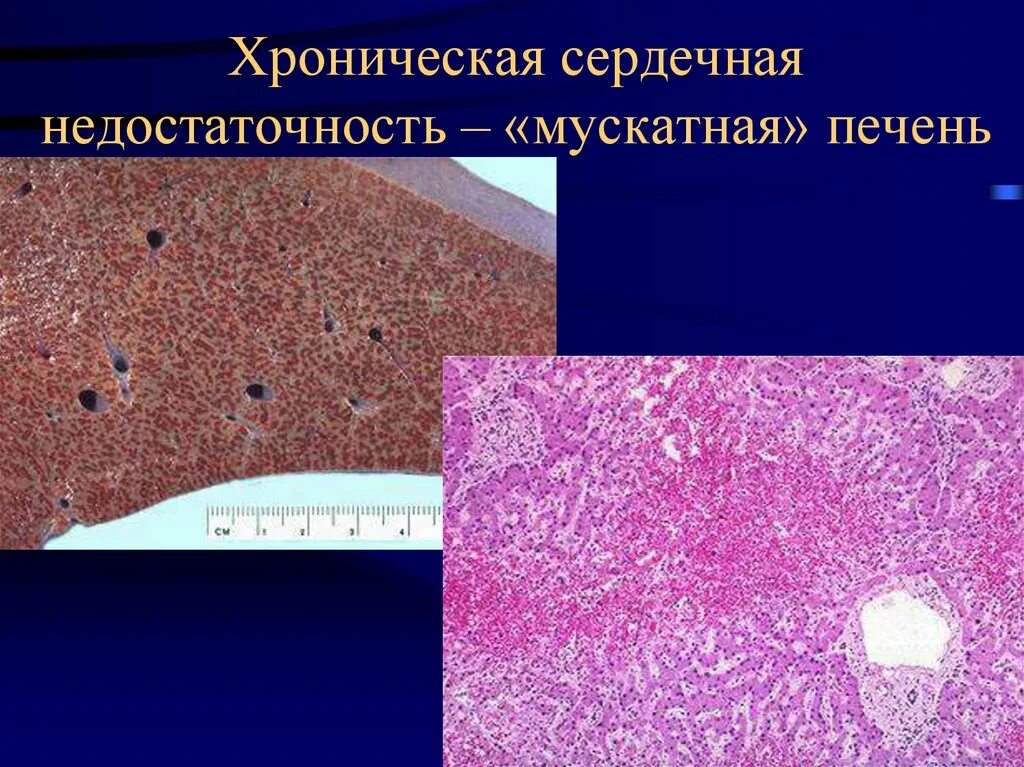 Хроническое полнокровие печени. Мускатный цирроз печени микропрепарат. Мускатная печень патанат. Мускатный цирроз печени макропрепарат. Патологическая анатомия макропрепарат мускатная печень.