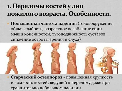 Перелом человека