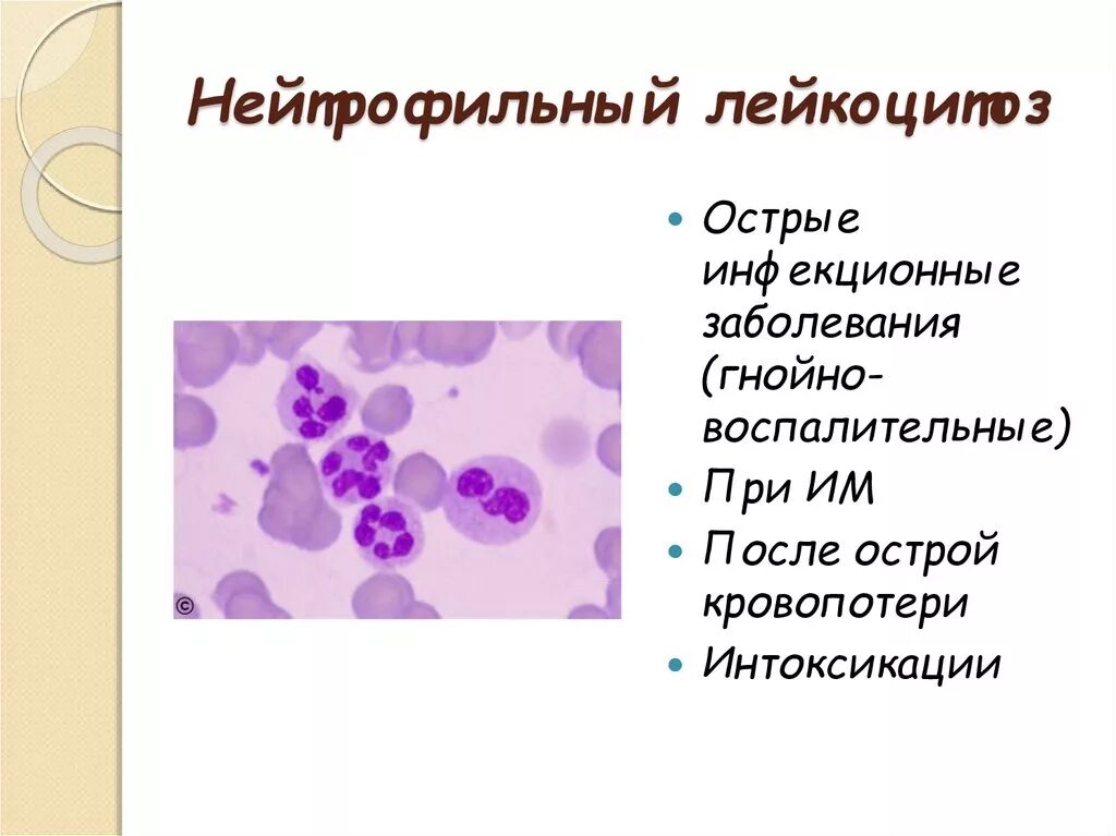 При острых инфекционных заболеваниях число лейкоцитов в крови. Нейтрофильный лейкоцитоз при. Лейкоцитоз при инфекционных заболеваниях. Типы нейтрофильных лейкоцитозов.. Лейкоцитоз нейтрофилы