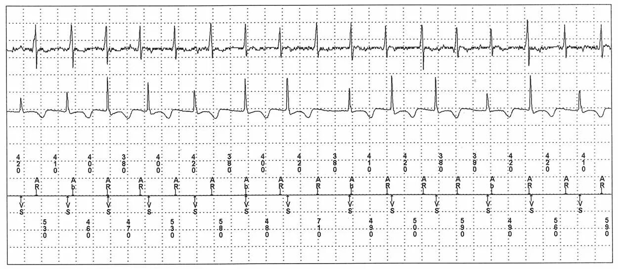 Предсердная тахикардия с АВ блокадой 2. Предсердная тахикардия с АВ блокадой. Наджелудочковая экстрасистолия на ЭКГ. Предсердная тахикардия с АВ блокадой 2 степени.