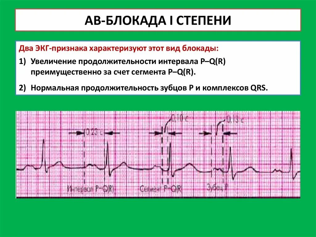 Блокада на первом. Степени атриовентрикулярной блокады на ЭКГ. ЭКГ критерии АВ блокады 1 степени. Неполная АВ блокада 1 степени на ЭКГ. ЭКГ признаки АВ-блокады i ст.