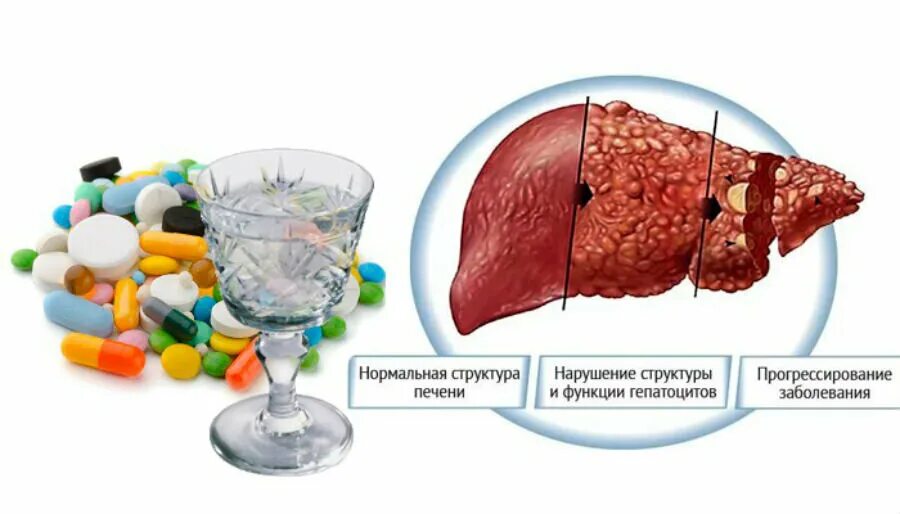 Антимикгтики и алкоголь. Антибиотики и алкоголь. Антибиотикотерапия и алкоголь. Негативное воздействие антибиотиков. Когда можно употреблять после антибиотиков