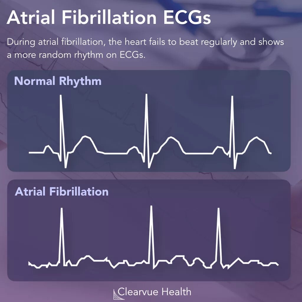 Работает fib звук. Atrial fibrillation. atrial fibrillation ecg. afib ecg. atrial fibrillation diagnosis.