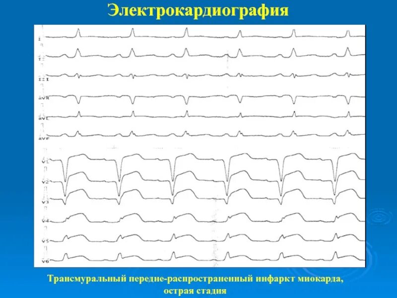 Трансмуральный инфаркт лечение. Передний распространенный инфаркт. острая стадия трансмурального инфаркта.