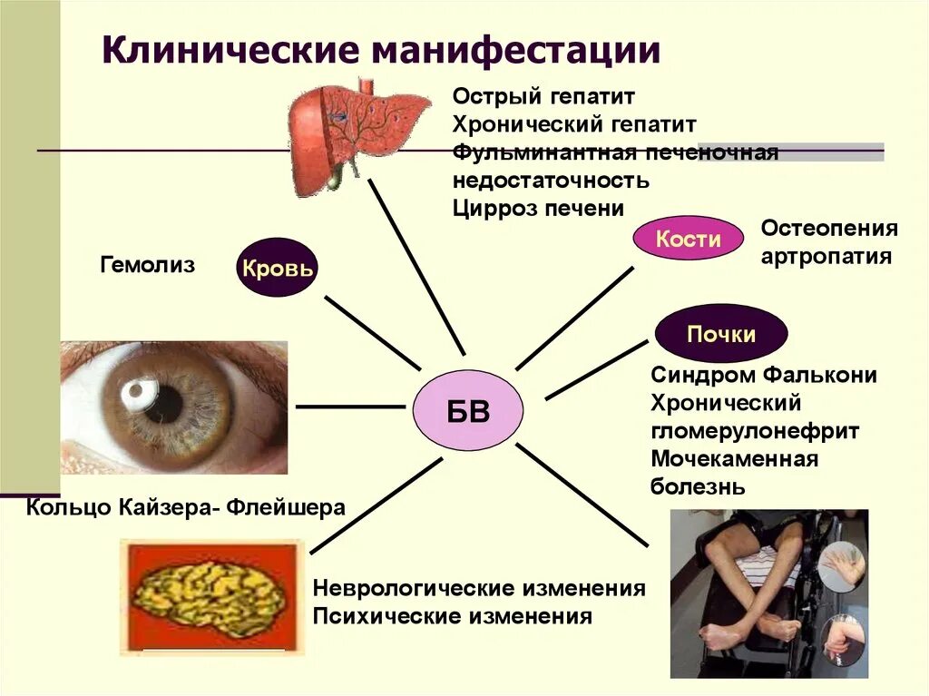 Синдром вильсона коновалова что это такое простыми. Болезнь Вильсона Коновалова фенотип. Гепатоцеребральная дистрофия (болезнь Вильсона). Вильсона Коновалова печень. Цирроз печени Вильсона Коновалова.