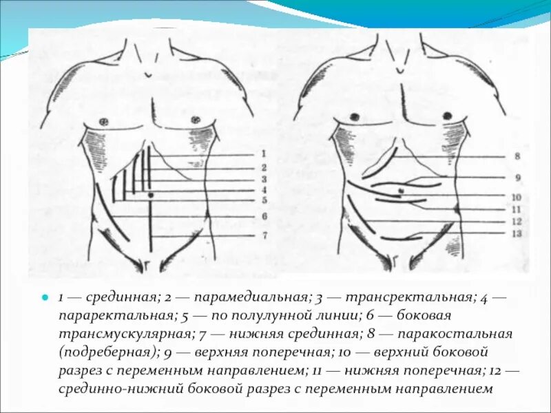 Срединная лапаротомия; параректальная лапаротомия.. Нижнесреднинная лапаротомия. Нижняя срединная лапаротомия. Нижняя поперечная лапаротомия. Нижняя лапаротомия