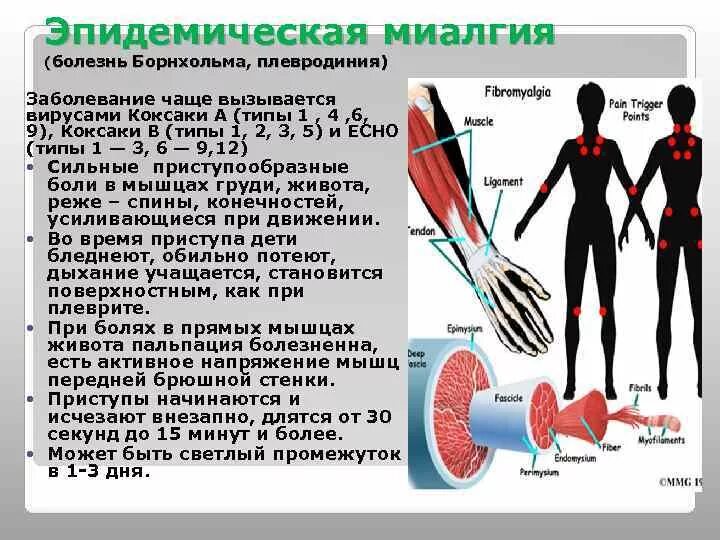 Миалгия мышц. Эпидемическая миалгия симптомы.